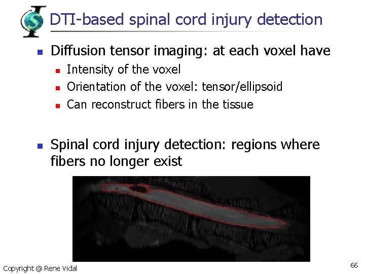 DTI-based spinal cord injury detection n Diffusion tensor imaging: at each voxel have n