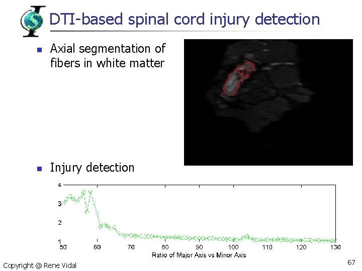 DTI-based spinal cord injury detection n n Axial segmentation of fibers in white matter