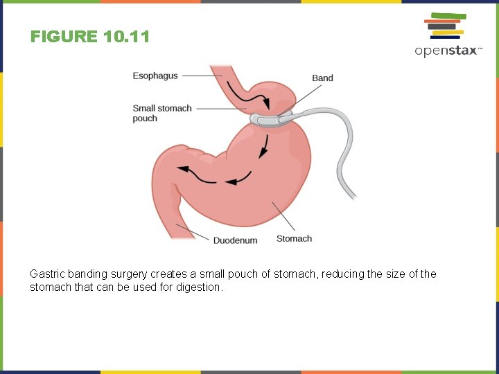 FIGURE 10. 11 Gastric banding surgery creates a small pouch of stomach, reducing the
