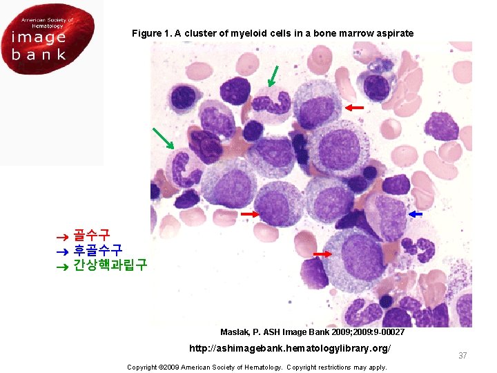 Figure 1. A cluster of myeloid cells in a bone marrow aspirate 골수구 후골수구