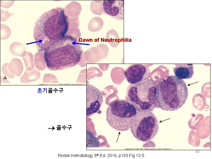 Dawn of Neutrophilia 초기골수구 Rodak Hematology 5 th Ed. 2016, p 153 Fig 12