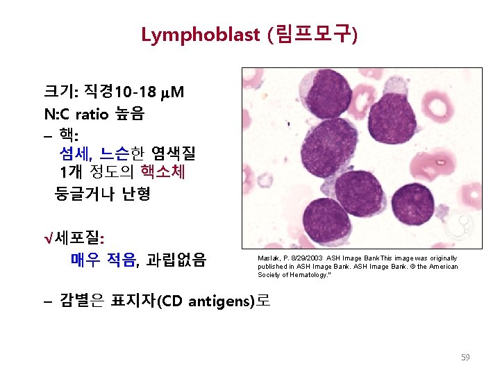 Lymphoblast (림프모구) 크기: 직경 10 -18 M N: C ratio 높음 – 핵: 섬세,