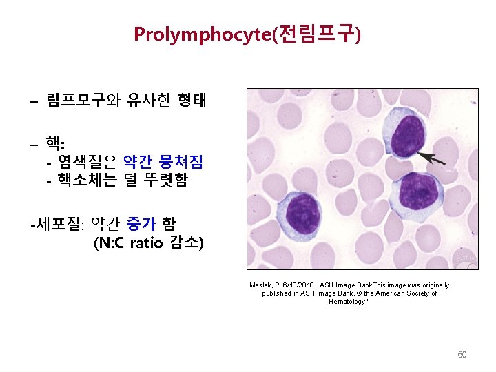 Prolymphocyte(전림프구) – 림프모구와 유사한 형태 – 핵: - 염색질은 약간 뭉쳐짐 - 핵소체는 덜