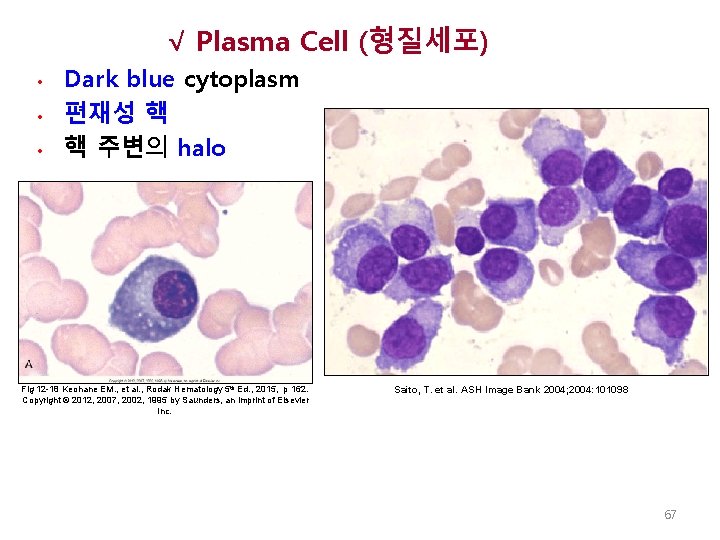 √ Plasma Cell (형질세포) • • • Dark blue cytoplasm 편재성 핵 핵 주변의
