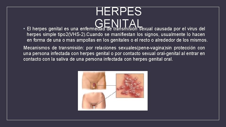 HERPES GENITAL • El herpes genital es una enfermedad de transmisión sexual causada por