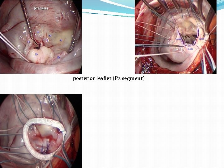 posterior leaflet (P 2 segment) 