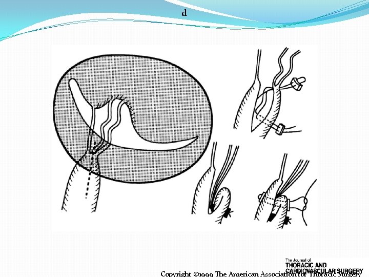 d Copyright © 1999 The American Association for Thoracic Surgery 