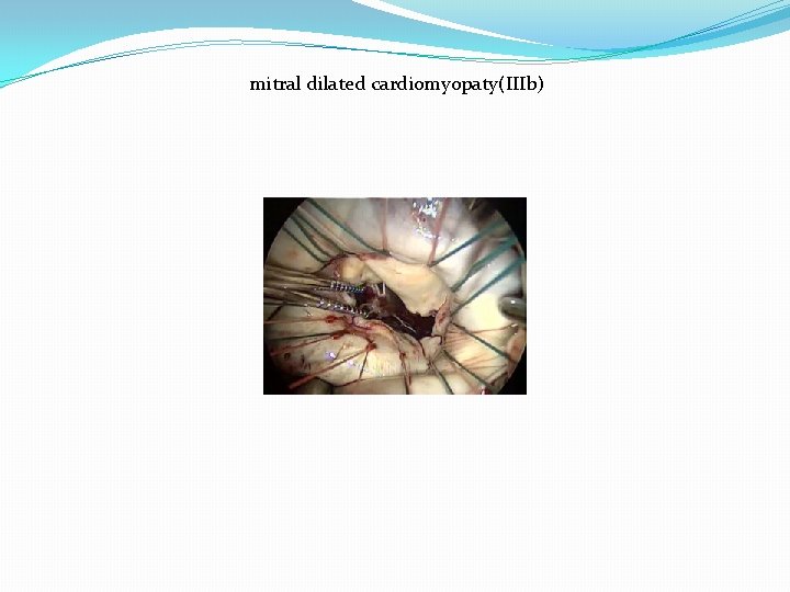 mitral dilated cardiomyopaty(IIIb) 