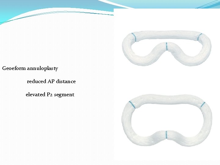 Geoeform annuloplasty reduced AP distance elevated P 2 segment 