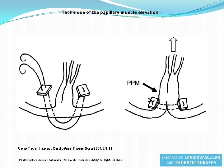 Technique of the papillary muscle elevation. Ueno T et al. Interact Cardio. Vasc Thorac