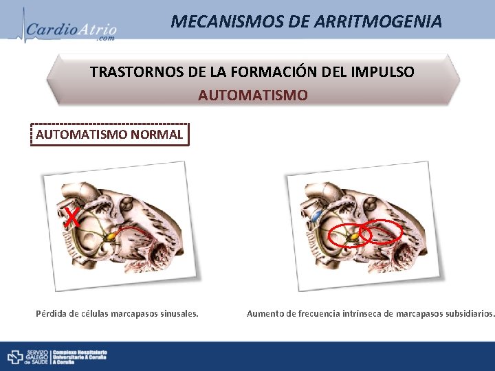 MECANISMOS DE ARRITMOGENIA TRASTORNOS DE LA FORMACIÓN DEL IMPULSO AUTOMATISMO NORMAL x Pérdida de MECANISMOS DE ARRITMOGENIA TRASTORNOS DE LA FORMACIÓN DEL IMPULSO AUTOMATISMO NORMAL x Pérdida de