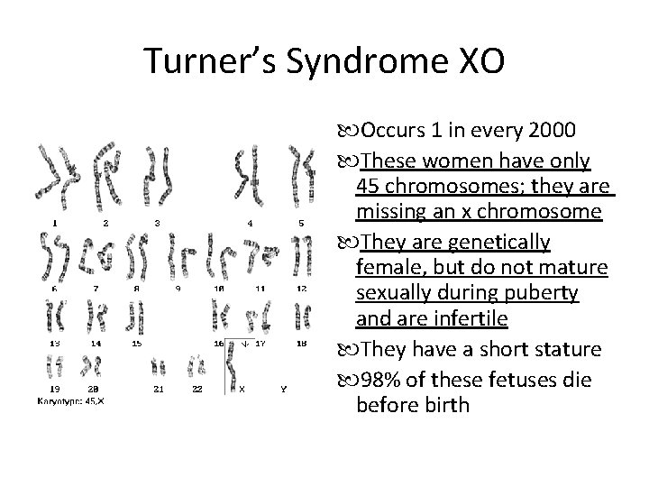 Turner’s Syndrome XO Occurs 1 in every 2000 These women have only 45 chromosomes;