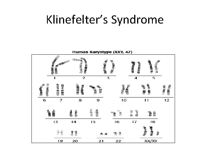 Klinefelter’s Syndrome 