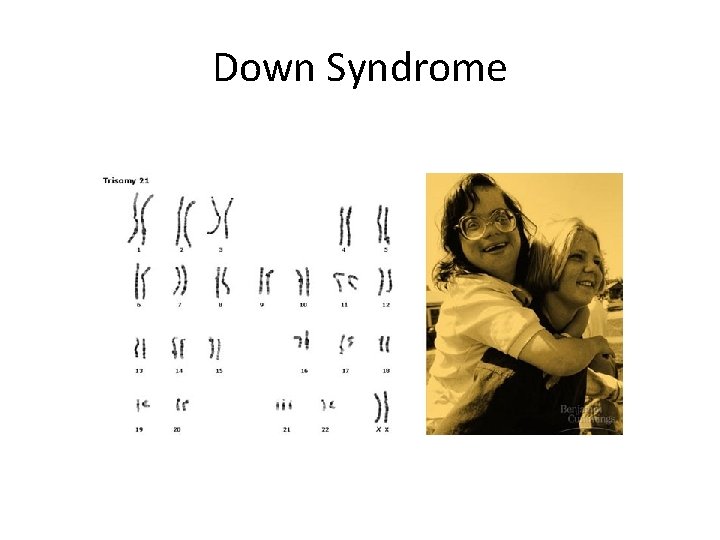 Down Syndrome 