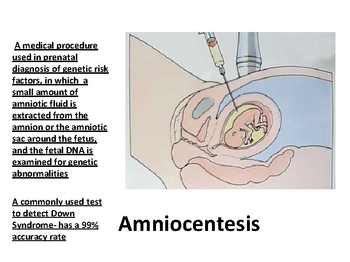 A medical procedure used in prenatal diagnosis of genetic risk factors, in which a