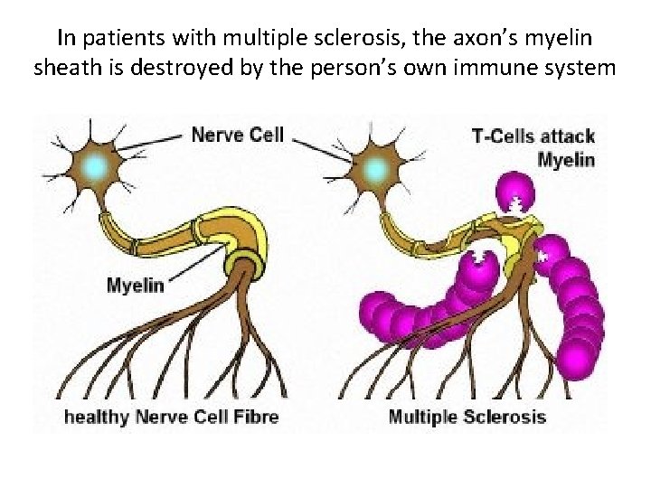 In patients with multiple sclerosis, the axon’s myelin sheath is destroyed by the person’s