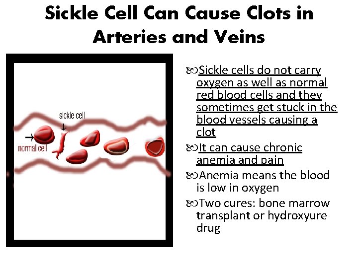 Sickle Cell Can Cause Clots in Arteries and Veins Sickle cells do not carry