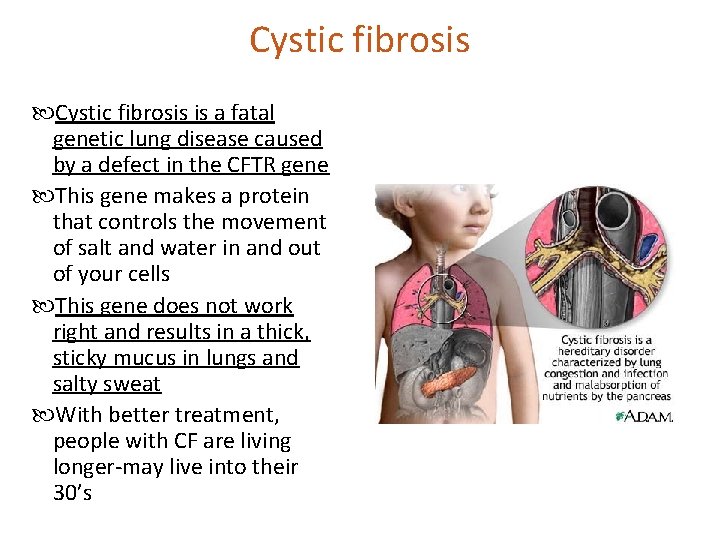 Cystic fibrosis is a fatal genetic lung disease caused by a defect in the