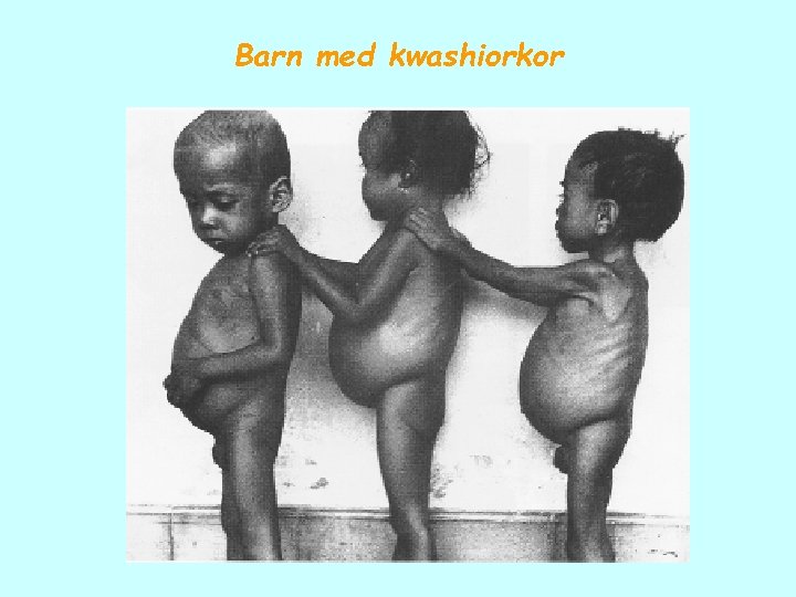 Barn med kwashiorkor 