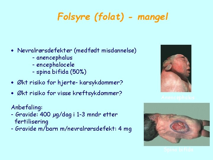 Folsyre (folat) - mangel Nevralrørsdefekter (medfødt misdannelse) - anencephalus - encephalocele - spina bifida