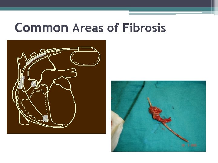 Common Areas of Fibrosis 