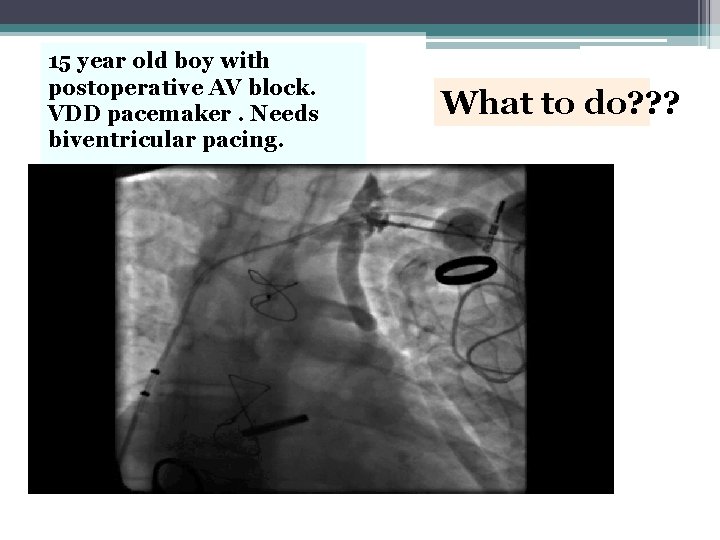 15 year old boy with postoperative AV block. VDD pacemaker. Needs biventricular pacing. What