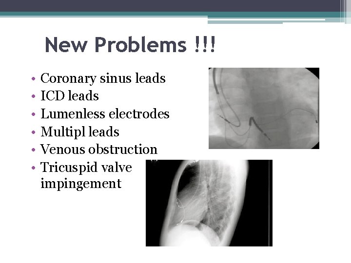 New Problems !!! • • • Coronary sinus leads ICD leads Lumenless electrodes Multipl