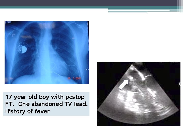 17 year old boy with postop FT. One abandoned TV lead. History of fever
