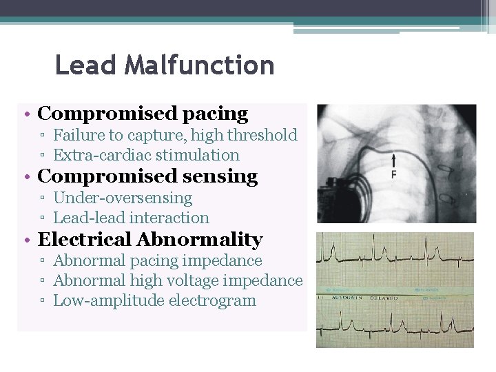 Lead Malfunction • Compromised pacing ▫ Failure to capture, high threshold ▫ Extra-cardiac stimulation