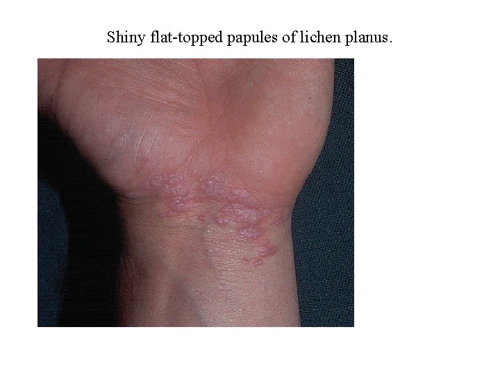 Shiny flat-topped papules of lichen planus. 