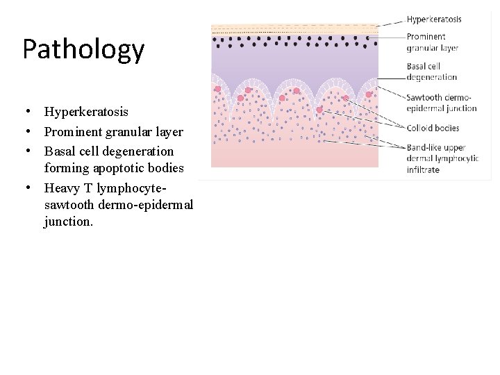 Pathology • Hyperkeratosis • Prominent granular layer • Basal cell degeneration forming apoptotic bodies
