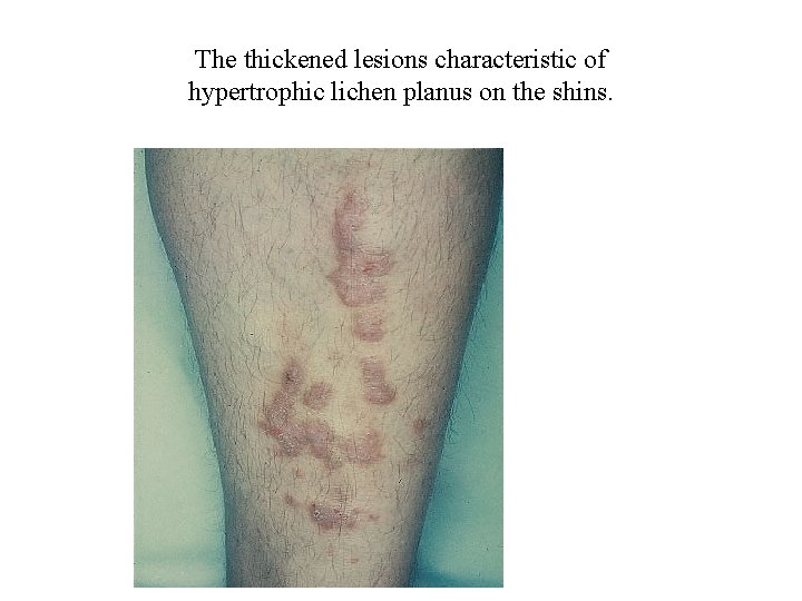 The thickened lesions characteristic of hypertrophic lichen planus on the shins. 