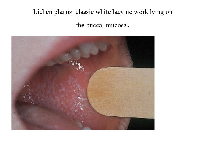 Lichen planus: classic white lacy network lying on the buccal mucosa . 