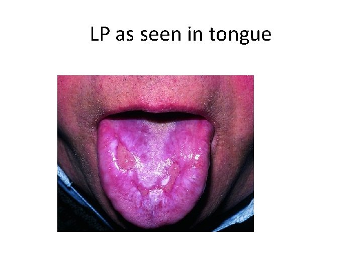 LP as seen in tongue 