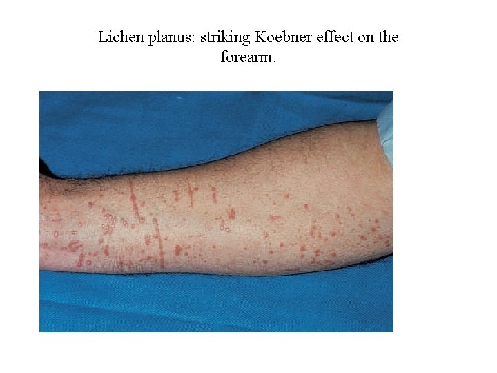 Lichen planus: striking Koebner effect on the forearm. 