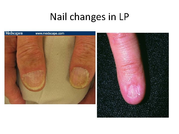 Nail changes in LP 