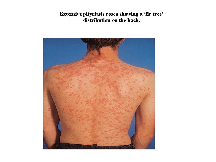 Extensive pityriasis rosea showing a ‘fir tree’ distribution on the back. 