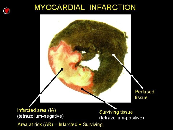 MYOCARDIAL INFARCTION Perfused tissue Infarcted area (IA) (tetrazolium-negative) Surviving tissue (tetrazolium-positive) Area at risk