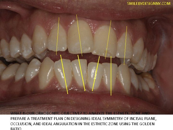 SMILEBYDESIGNNY. COM WHAT IS OUR ORHODONITC OBJECTIVE? TO ANALYZE THE ESTHETIC ZONE AND PREPARE