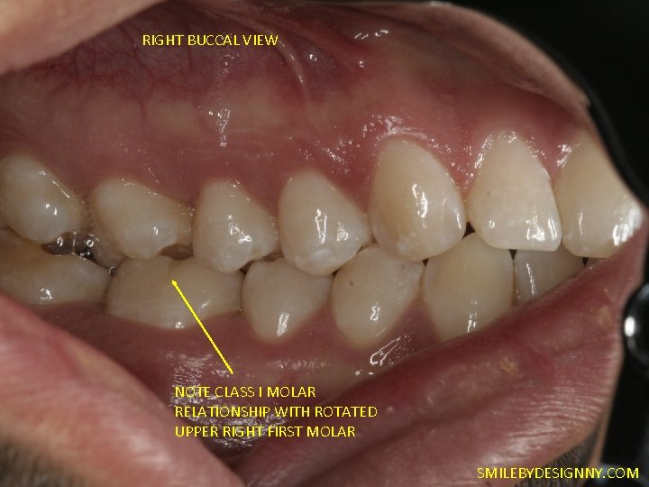 RIGHT BUCCAL VIEW NOTE CLASS I MOLAR RELATIONSHIP WITH ROTATED UPPER RIGHT FIRST MOLAR