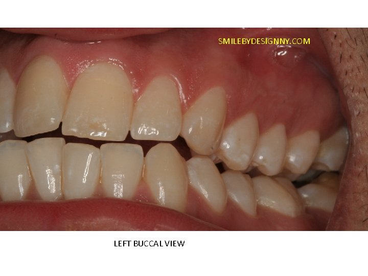 SMILEBYDESIGNNY. COM LEFT BUCCAL VIEW 