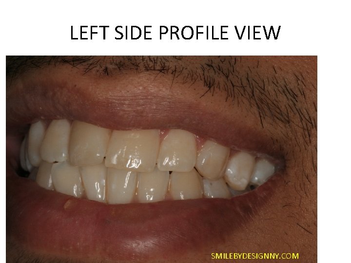 LEFT SIDE PROFILE VIEW SMILEBYDESIGNNY. COM 