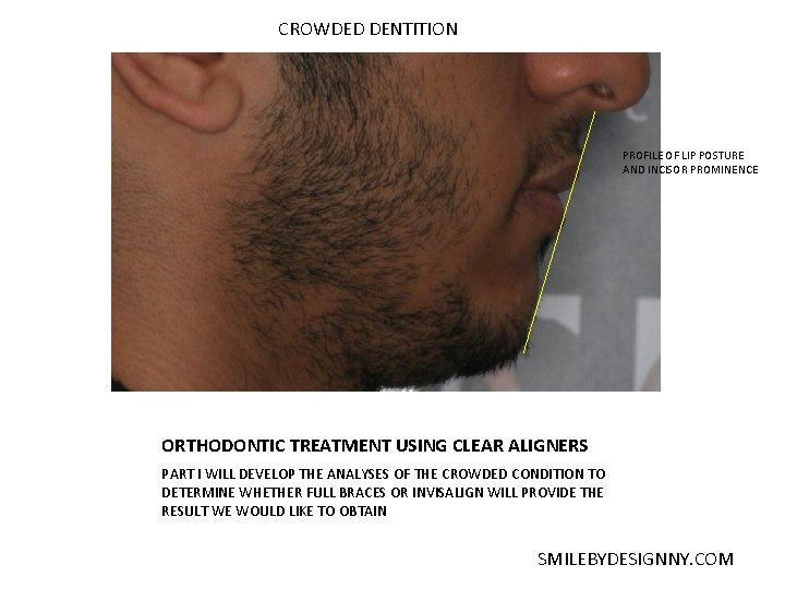 CROWDED DENTITION PROFILE OF LIP POSTURE AND INCISOR PROMINENCE ORTHODONTIC TREATMENT USING CLEAR ALIGNERS
