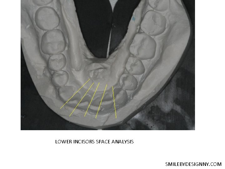 LOWER INCISORS SPACE ANALYSIS SMILEBYDESIGNNY. COM 