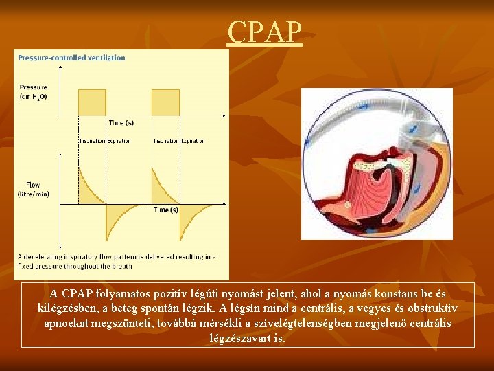 CPAP A CPAP folyamatos pozitív légúti nyomást jelent, ahol a nyomás konstans be és