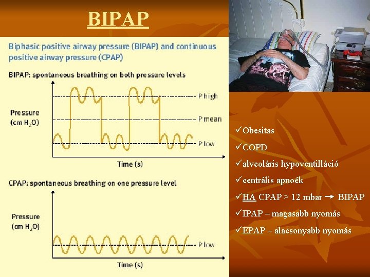 BIPAP üObesitas üCOPD üalveoláris hypoventilláció ücentrális apnoék üHA CPAP > 12 mbar BIPAP üIPAP