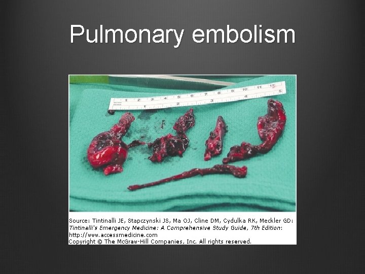 Pulmonary embolism 