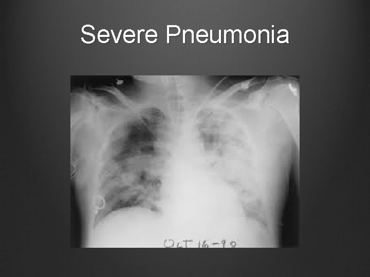 Severe Pneumonia 