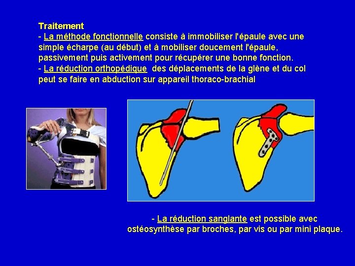 Traitement - La méthode fonctionnelle consiste à immobiliser l'épaule avec une simple écharpe (au