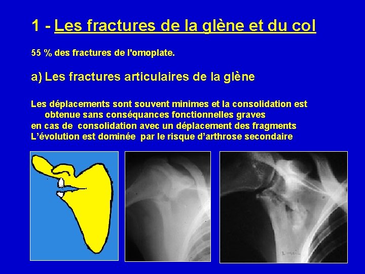 1 - Les fractures de la glène et du col 55 % des fractures